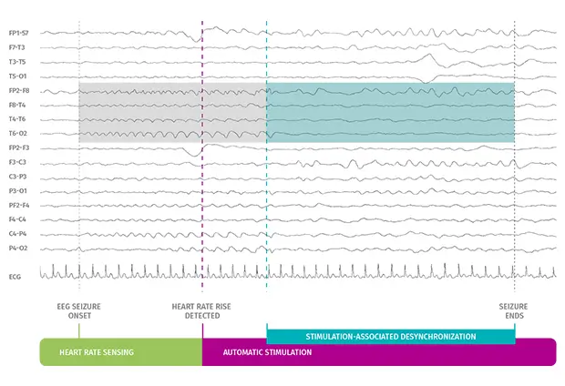 AspireSR-Page_EEG_Static