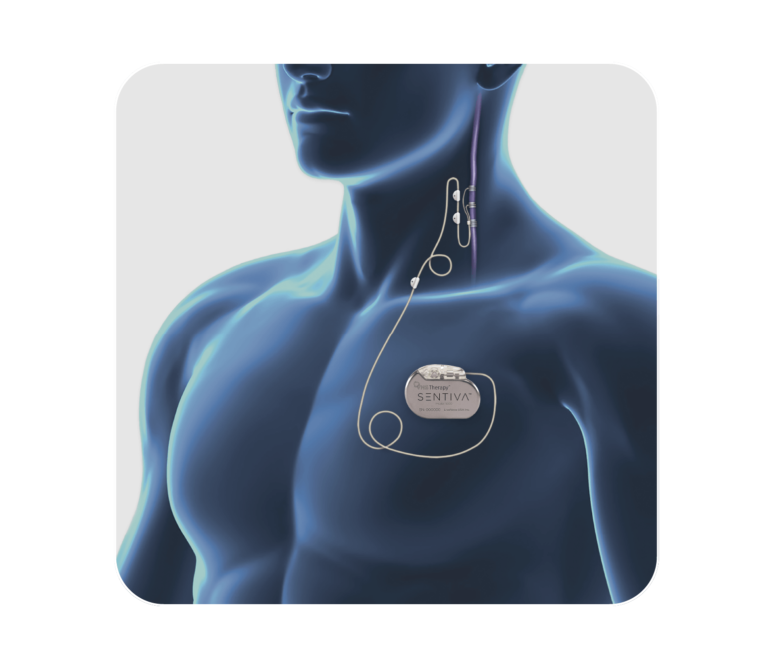SenTiva™ VNS Therapy device