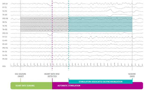 AspireSR™ detects and responds to rapid increases in heart rate that may be associated with a seizure