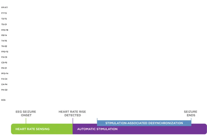 SenTiva™ detects and responds to rapid increases in heart rate that may be associated with a seizure