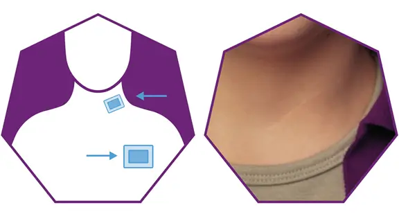 vagus nerve stimulation surgery scars and dressing